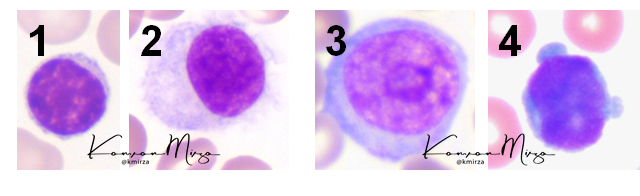 KMirza's tweet photo. #Hemepath #MorphologyQuiz #BloodSmear
Match cells 1-4 with diagnoses below https://t.co/cUJM31mDMx