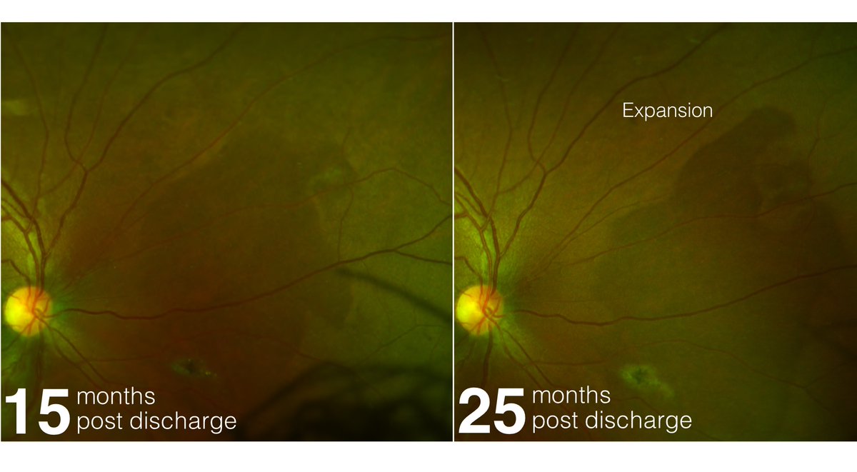 34MHEyeResearch's tweet photo. Can Ebola virus persist in the retina of asymptomatic survivors? Our latest publication demonstrates evolving areas of dark without pressure associated with Ebola retinal lesions https://t.co/k5zWTOmpF0 @pauljsteptoe #Ebola #Optos @TopconGB  @LivUni https://t.co/GFEw9HCILc