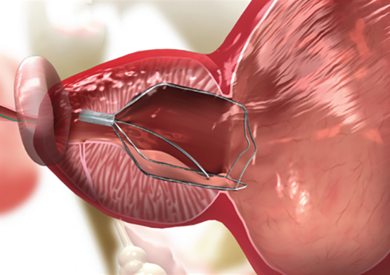 GizmoMD_'s tweet photo. iTind for Benign Prostatic Hyperplasia Gets FDA Green Light https://t.co/CcBz5cu1Ln #Urology https://t.co/uRdJL7DPrS