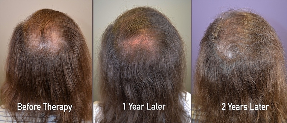 Amazing regrowth with medical therapy alone!
 #malepatternhairloss #finasteride #finasteride1mg #finasteridehairgrowth #minoxidil #oralminoxidil