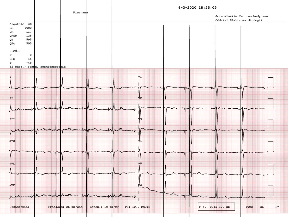 hisclinics's tweet photo. 43 y.o. female with dextrocardia and AV block. His bundle pacing? Difficult, yet possible.
@GardasRafal @drpmoskal @AnandShah_MD
@pjsm83 
#dontdisthehis #electrocardiology https://t.co/Ktcg4tk4oW