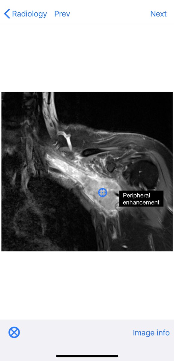 BoSTT_app's tweet photo. Case 97 now live in the app. Download if you don’t have it and enjoy 97 bone and soft tissue cases with learning points! @BoSTT_app #FOAMed #FOAMrad #MSKrad #BSTpath #pathology #radiology #sarcoma  (this case is S100 neg, CK and CD34 Positive) https://t.co/mB00b4ELwr
