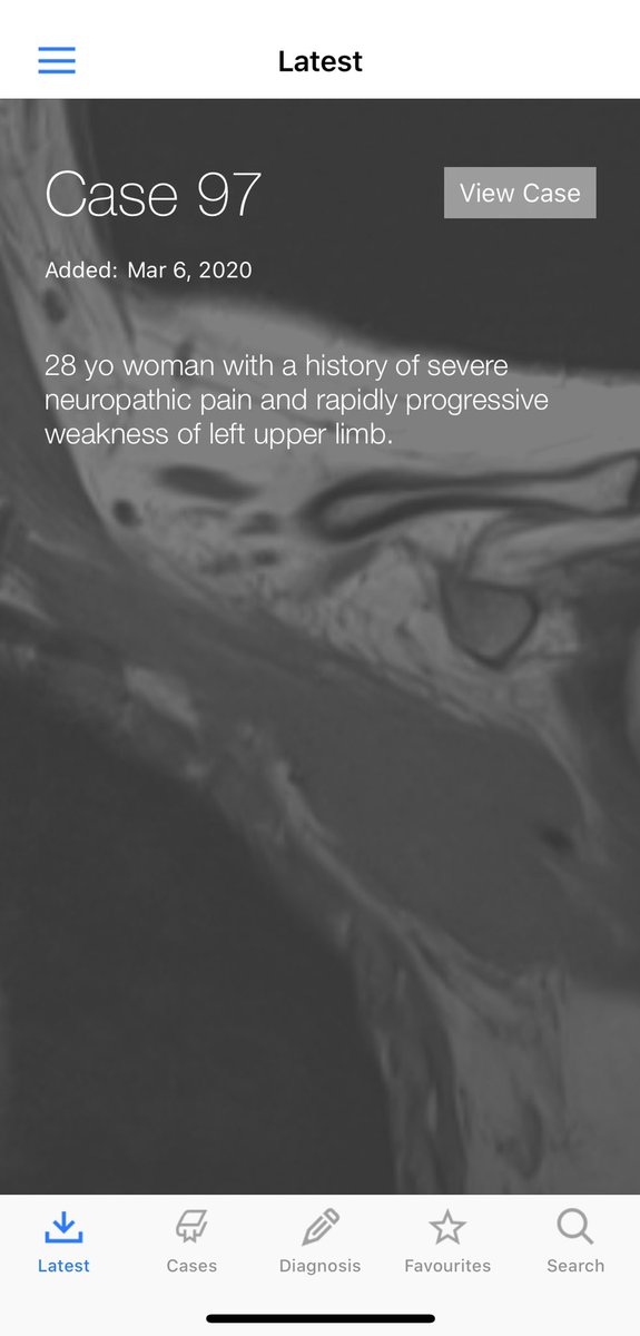 BoSTT_app's tweet photo. Case 97 now live in the app. Download if you don’t have it and enjoy 97 bone and soft tissue cases with learning points! @BoSTT_app #FOAMed #FOAMrad #MSKrad #BSTpath #pathology #radiology #sarcoma  (this case is S100 neg, CK and CD34 Positive) https://t.co/mB00b4ELwr
