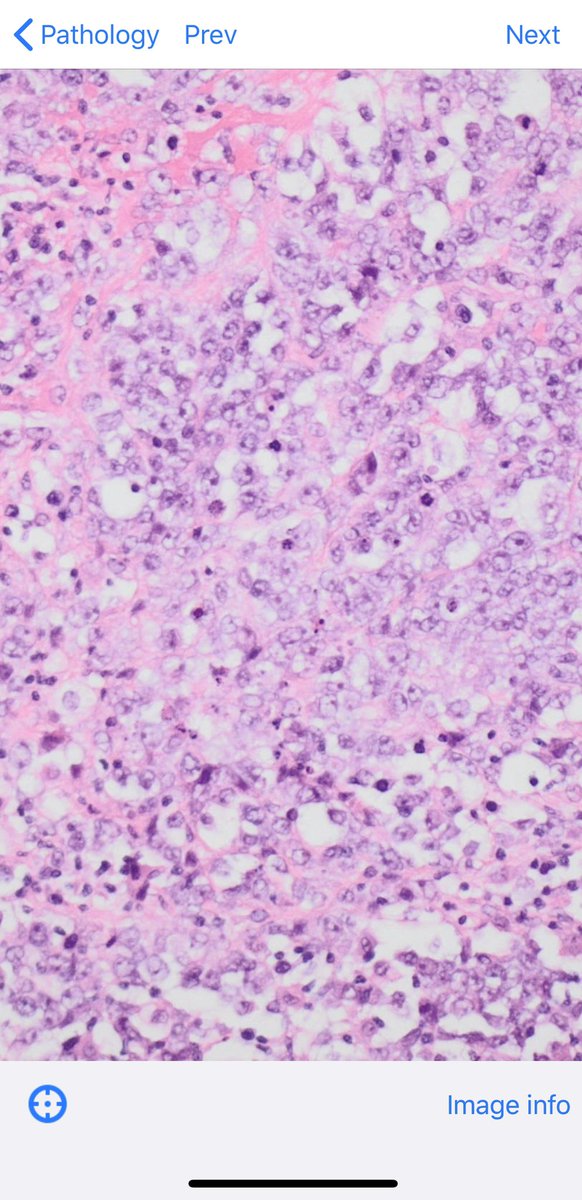 BoSTT_app's tweet photo. Case 97 now live in the app. Download if you don’t have it and enjoy 97 bone and soft tissue cases with learning points! @BoSTT_app #FOAMed #FOAMrad #MSKrad #BSTpath #pathology #radiology #sarcoma  (this case is S100 neg, CK and CD34 Positive) https://t.co/mB00b4ELwr