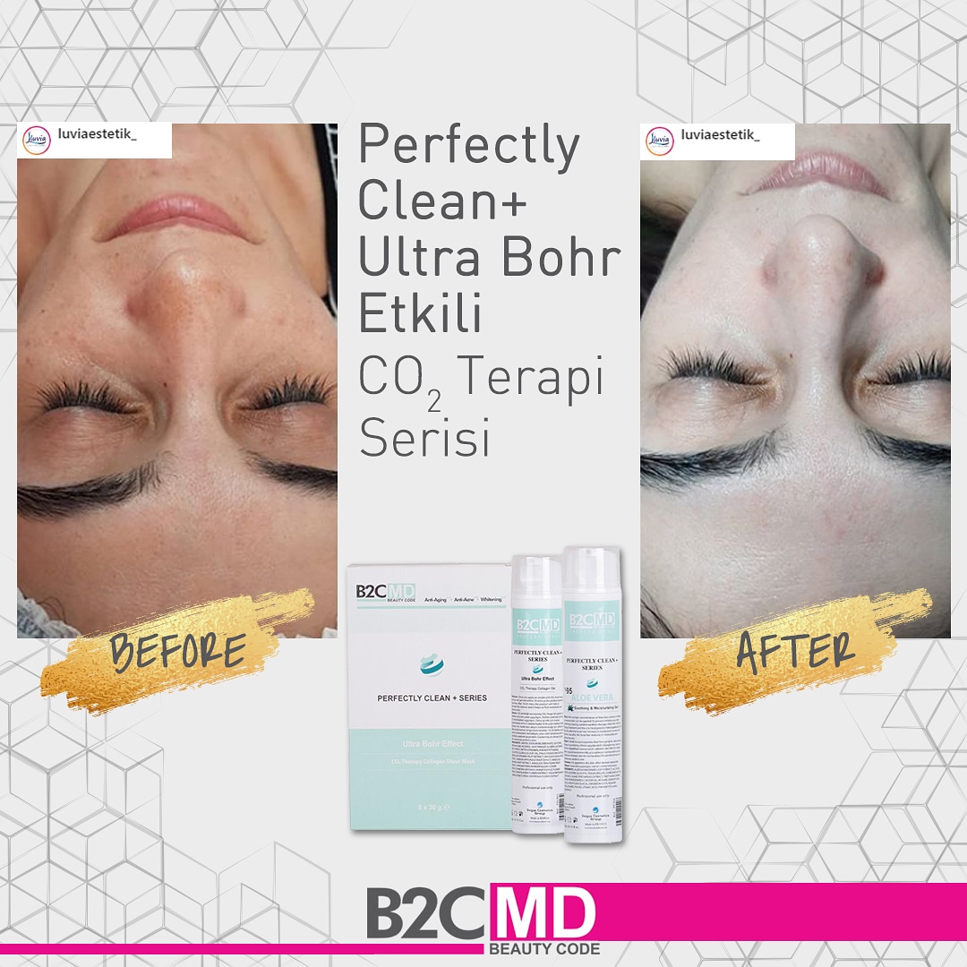 B2CMD's tweet photo. Perfectly Clean + Ultra Bohr Etkili  CO2 Terapi ile pırıl pırıl bir cilde kavuşun. https://t.co/SuQlzKpm9Q