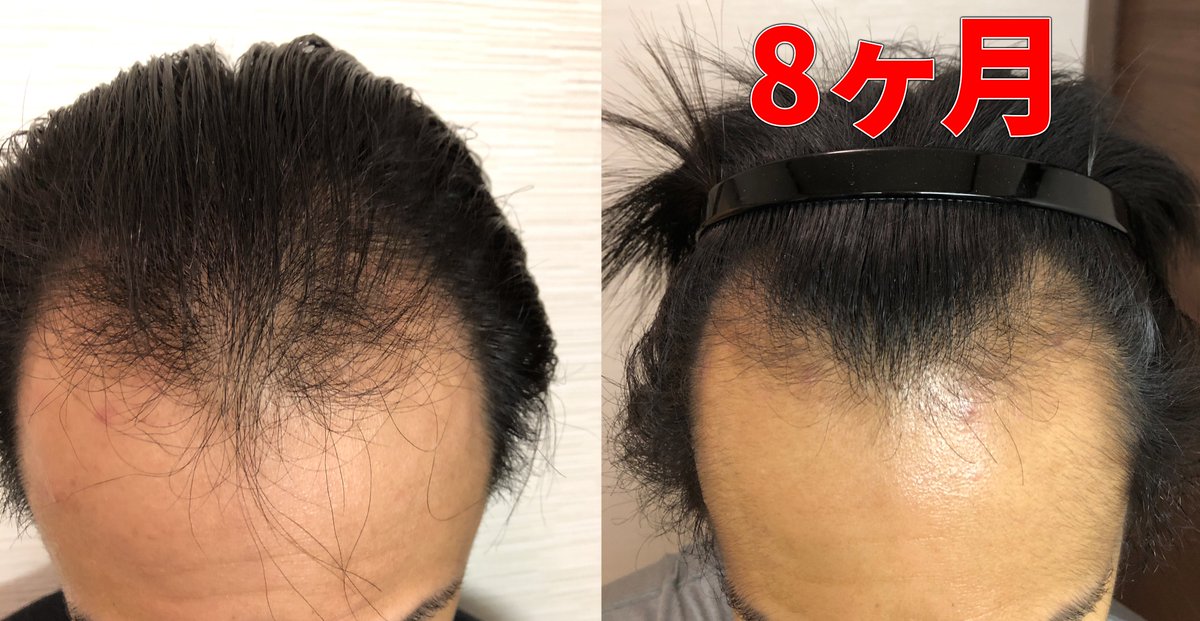 デコさん Aga治療中のm字ハゲ Aga治療16ヶ月目 以前の写真と見比べてももはや違いが分からない もうすぐ次の半年分の薬を買う時期だから このタイミングでフィナステリド増量しようかなぁ