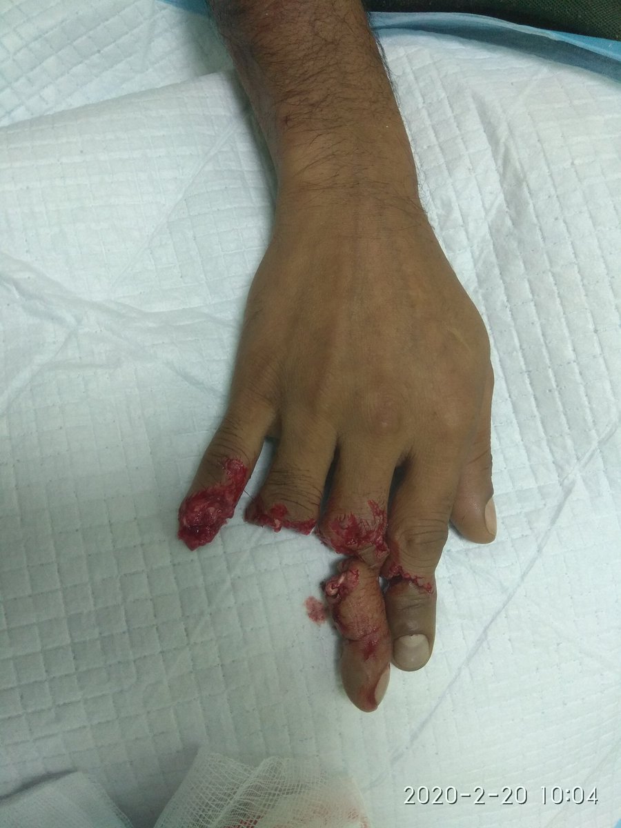 ds_reuben's tweet photo. Finger replant surgery is truly challenging. A race to join bone- tendon- artery- vein-nerve-skin for each finger. This is a triple finger replant. #supermicrosurgery #replantation. https://t.co/gqlLcr7lcO