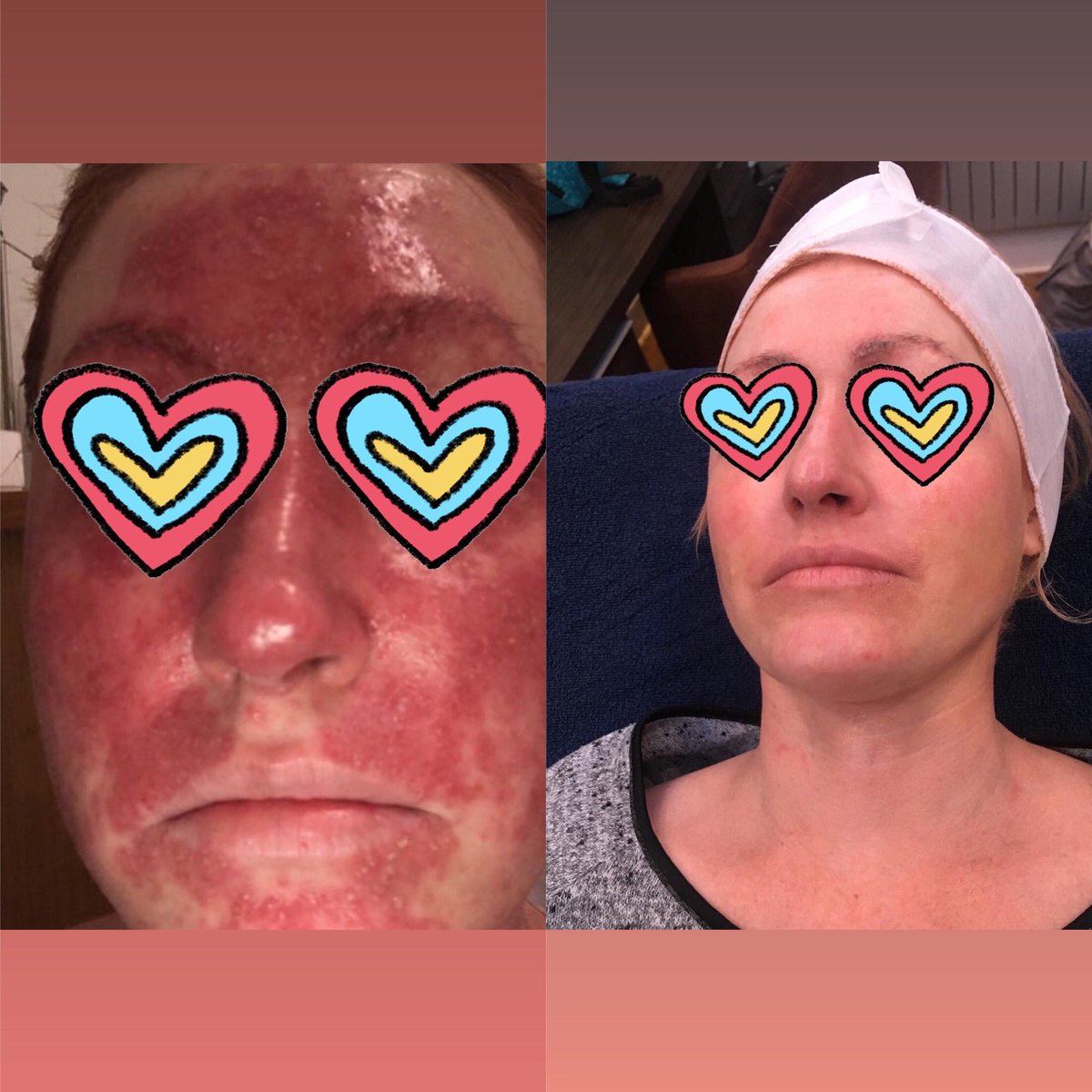 sparklethroughchemo on Twitter "chemoskin effects nearly 66 of