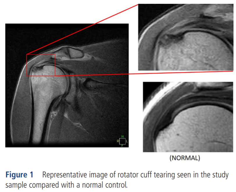DrSportSante's tweet photo. Are you sure you want to MRI the painful shoulder of that volleyball player? What are you going to do with the findings?

https://t.co/Ml7XwV8PBq

#overdiagnosis #imaging https://t.co/slhiC1kPA8