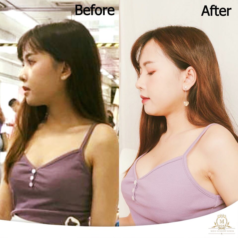 MindSurgery9's tweet photo. หน้าสวย ตัวเป๊ะ! เผ็ชเหมือนยกพริกมาทั้งสวน🔥
.
💃👉Mind Surgery Korea พาอัพเดทความงาม เคสผ่าตัดของคุณเดียร์  บิ้วตี้บล๊อกเกอร์คนสวย หลังเข้าการผ่าตัดมา 1 เดือน https://t.co/iDXffgbQYf