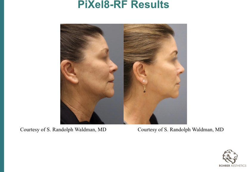 MyFineSkin's tweet image. Introducing Pixel-8 RF: Microneedling with Radio Frequency. Amazing laser for #skintightening #acnescars #porereduction #scars #wrinkles #necklift and much more! 😀