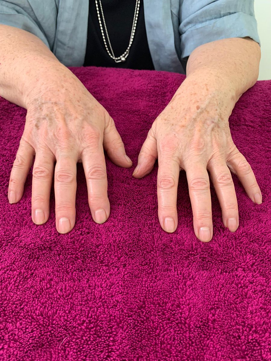 OpAestheticsRT's tweet photo. Your hands are constantly exposed to sun exposure, cold temperatures, pollution &amp; wind. Book in for a hand rejuvenating treatment starting from £25. Smooths out wrinkles &amp; lines, Refined skin texture, Reduces visible signs of ageing. See https://t.co/h2Tq0hm8uD to book! https://t.co/Tt1cj5HTxh