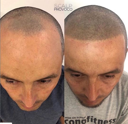 ScalpProvoco's tweet photo. Get the freshly shaven look with #SMP just look at these results! #balding #hairloss #menshair #menshairloss https://t.co/TTc9qSGssB