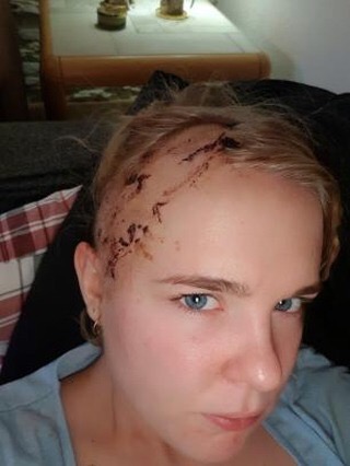 globalepilepsy's tweet photo. “Hi, my name is Line Kinnerup. I have had epilepsy all my life. I have tried a million different medicines and nothing works. So now the doctors want to see if they can give me the big surgery...” https://t.co/Wa7LXk2bZa
