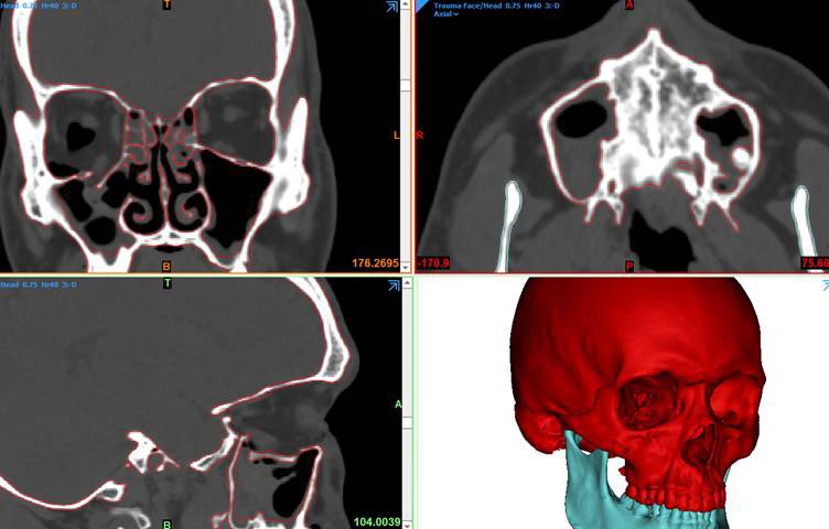 JayMorris_MD's tweet photo. Repairing post traumatic #orbit floor #fractures by @sharaf_basel may need custom plates. #3Dprinting using #mirror image contralateral #normal to prebend plates prevents abnl #cosmetic appearance #enopthalmos or worse #dioloplia  @MayoClinic @MayoRadiology #plasticsurgery #hope https://t.co/haXvYV9dca