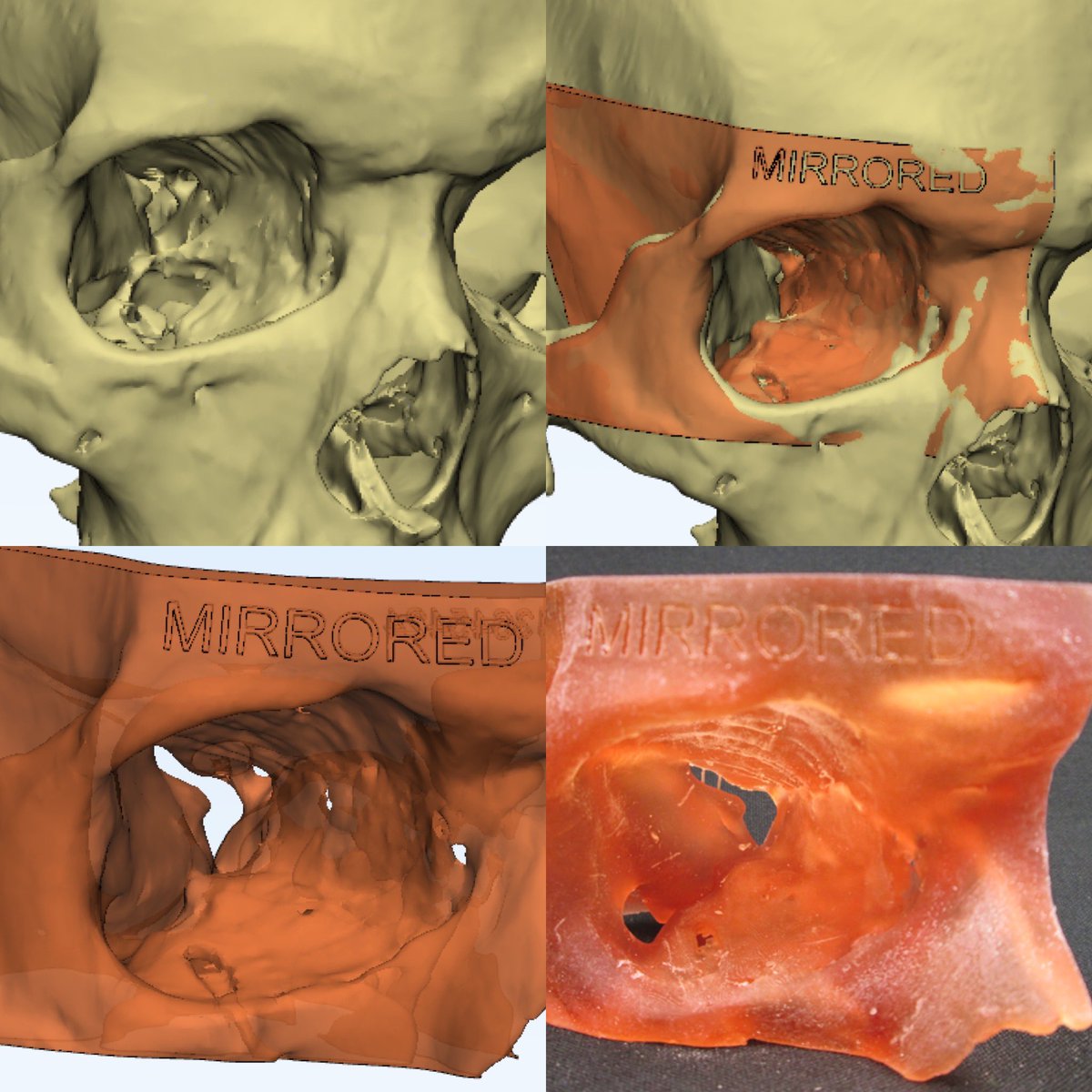 JayMorris_MD's tweet photo. Repairing post traumatic #orbit floor #fractures by @sharaf_basel may need custom plates. #3Dprinting using #mirror image contralateral #normal to prebend plates prevents abnl #cosmetic appearance #enopthalmos or worse #dioloplia  @MayoClinic @MayoRadiology #plasticsurgery #hope https://t.co/haXvYV9dca