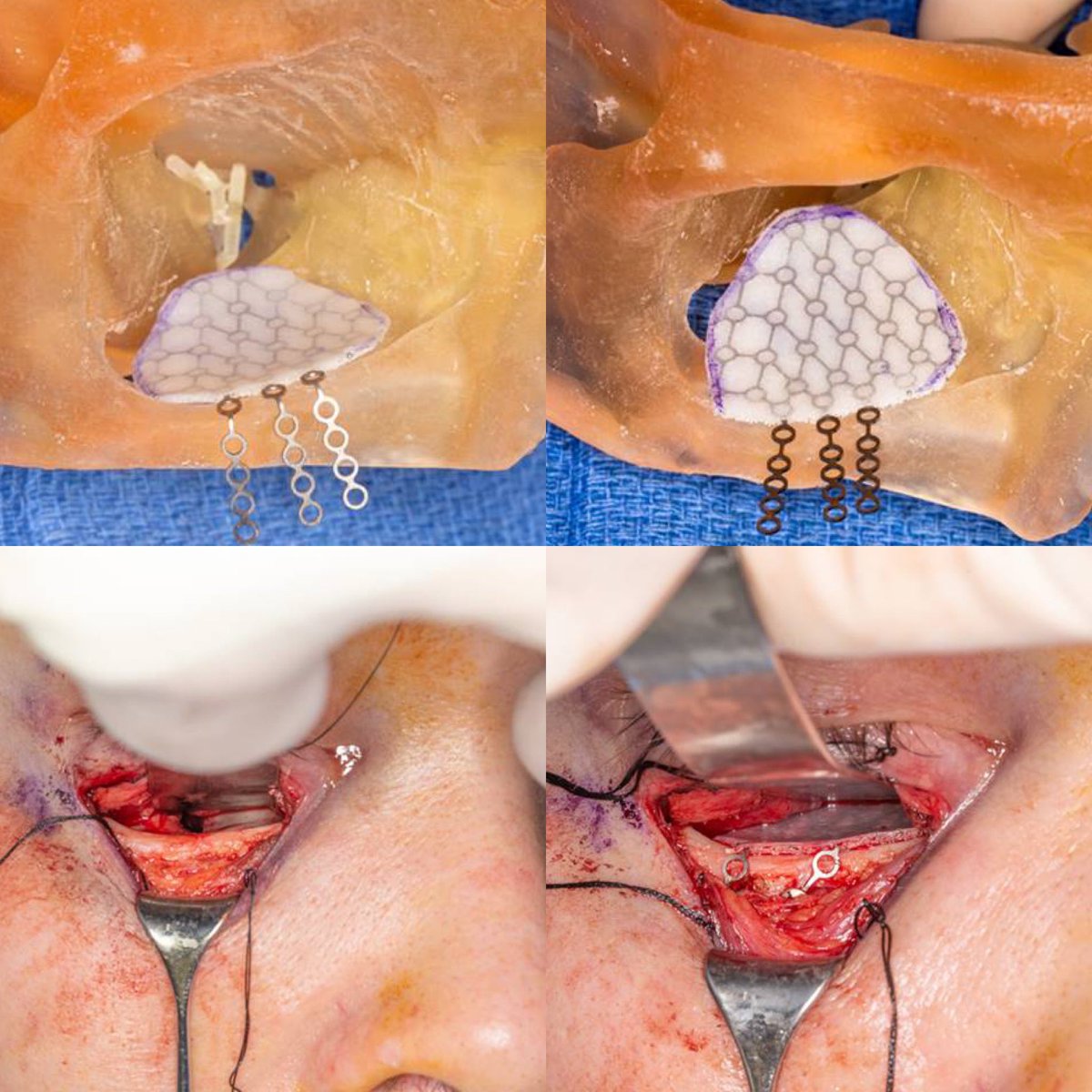 JayMorris_MD's tweet photo. Repairing post traumatic #orbit floor #fractures by @sharaf_basel may need custom plates. #3Dprinting using #mirror image contralateral #normal to prebend plates prevents abnl #cosmetic appearance #enopthalmos or worse #dioloplia  @MayoClinic @MayoRadiology #plasticsurgery #hope https://t.co/haXvYV9dca