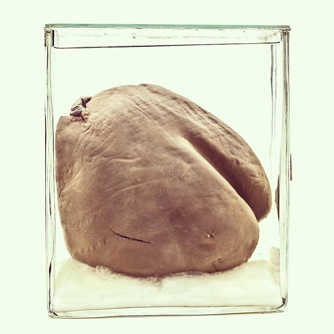 museumweirdo's tweet photo. Liver that was deformed by a woman's corset pushing her ribs against her internal organs, which is why I am only wearing sweatpants with a blown out waistband from now on.
From the collection of the Mütter Museum, Philadelphia. #medicalmuseum #sweatpantsforlife https://t.co/FucDemsy2i