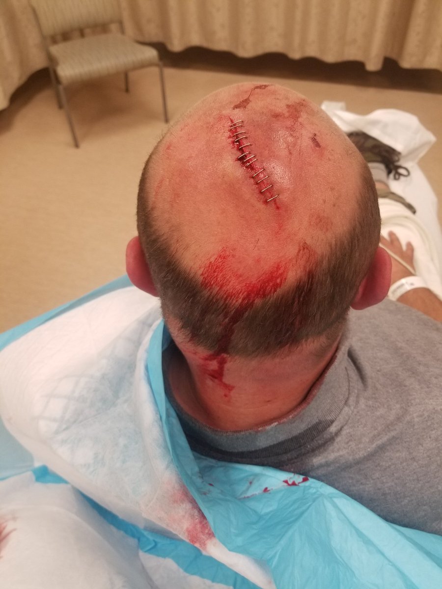 Ramblingsidt1's tweet photo. #myFebruary
6 inch gash 12 staples https://t.co/hiNGA9wA73