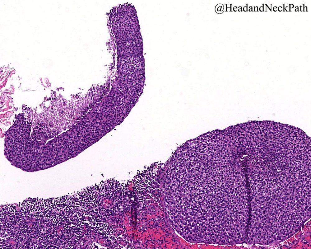 3rd talk from NASHNP Society Meeting @ 109th USCAP (03-2020):
Human Papillomavirus Testing in Head and Neck Squamous Cell Carcinoma in 2020: Where Are We Now and Where Are We Going?
rdcu.be/b2wwA
#HeadNeckPathol #HNPJ #HeadandNeckPath #Pathology #ENTPath #PathologyTweet