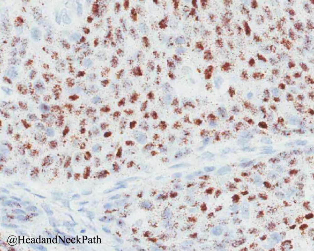 3rd talk from NASHNP Society Meeting @ 109th USCAP (03-2020):
Human Papillomavirus Testing in Head and Neck Squamous Cell Carcinoma in 2020: Where Are We Now and Where Are We Going?
rdcu.be/b2wwA
#HeadNeckPathol #HNPJ #HeadandNeckPath #Pathology #ENTPath #PathologyTweet
