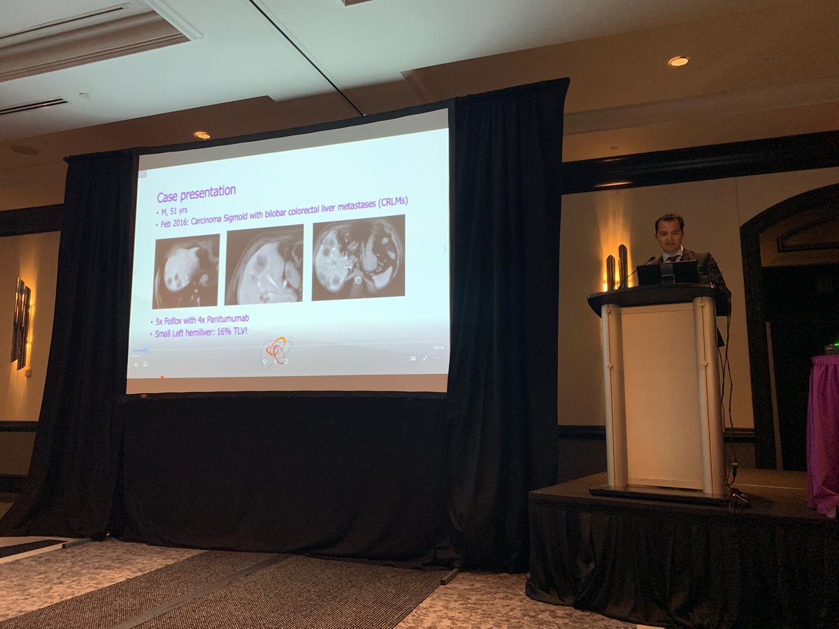 HondtMathieu's tweet photo. Grateful to present our video on laparoscopic ALPPS procedure to treat extensive colorectal liver metastases at the annual AHPBA meeting in Miami. Three years later NED. #AHPBA20 @azgroeninge @LoicBaekelandt @KOTKanker https://t.co/3Ys9LNDrdD