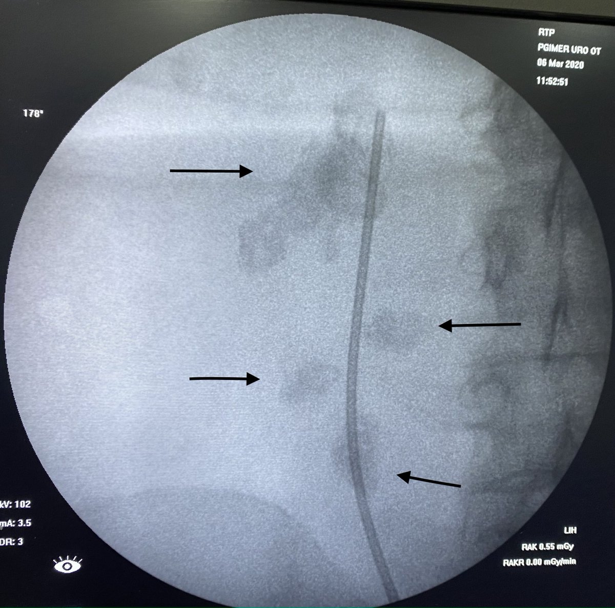 SudheerDevana's tweet photo. #PNL in a horseshoe kidney with #stones scattered in inferior compound #calyces is always a challenging. Needs lot of planning intraoperatively with increased #radiation exposure. #UroSomeIndia @rbsabnis @DrVCMohan @mallikuro7 @ShashiKiranPal #endourology https://t.co/390OIh3MXo