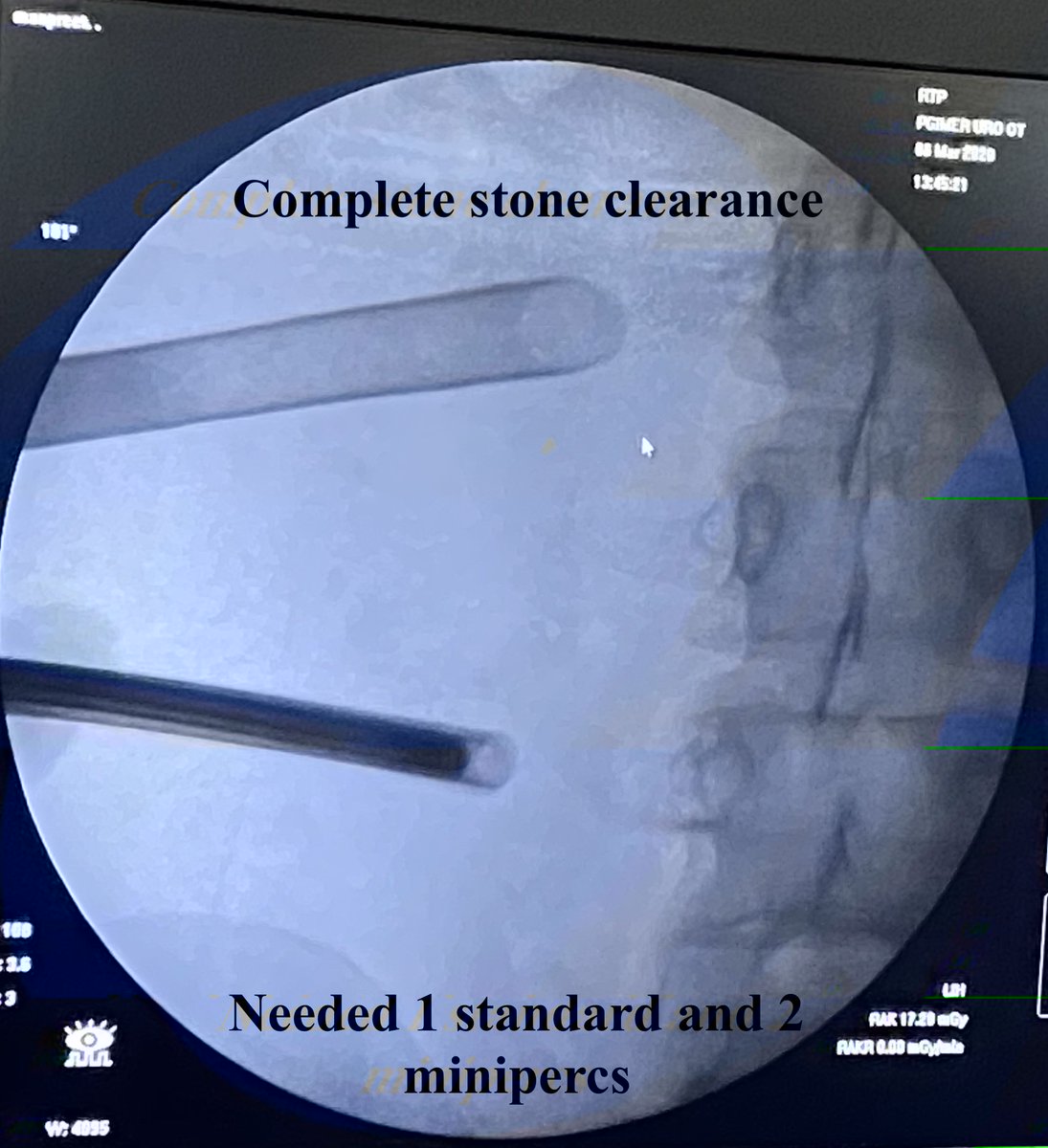 SudheerDevana's tweet photo. #PNL in a horseshoe kidney with #stones scattered in inferior compound #calyces is always a challenging. Needs lot of planning intraoperatively with increased #radiation exposure. #UroSomeIndia @rbsabnis @DrVCMohan @mallikuro7 @ShashiKiranPal #endourology https://t.co/390OIh3MXo