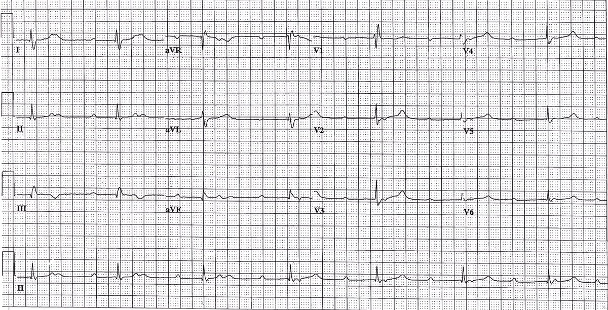 PPodrid's tweet photo. ECG for the weekend. #PodridECG #ECG #meded #cardiotwitter https://t.co/a20PGVfeZP