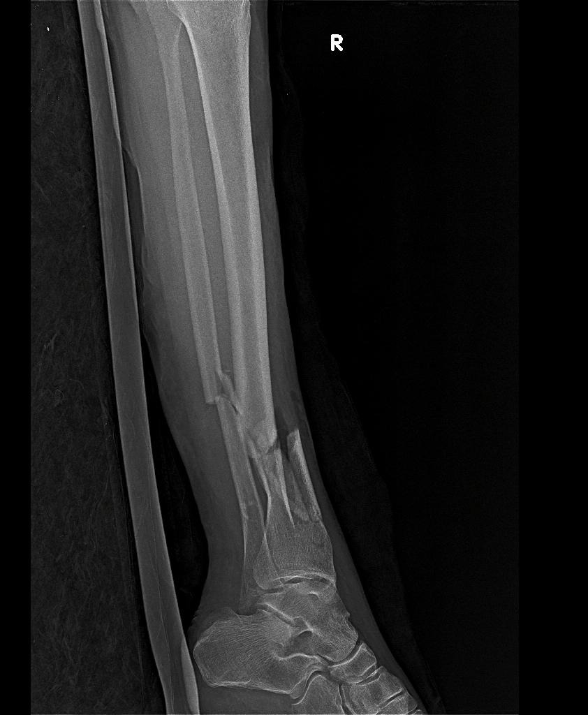 RamanathSharath's tweet photo. Comminuted distal tibia # with segmental fibula #.
Expert tibia nail
#sharath #sharathortho #orthopedics #fracturesurgery #crif https://t.co/OEx3BAFT7U