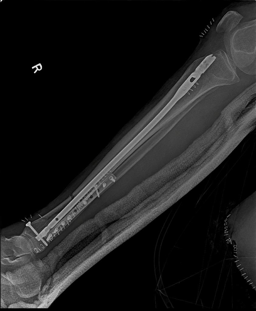 RamanathSharath's tweet photo. Comminuted distal tibia # with segmental fibula #.
Expert tibia nail
#sharath #sharathortho #orthopedics #fracturesurgery #crif https://t.co/OEx3BAFT7U