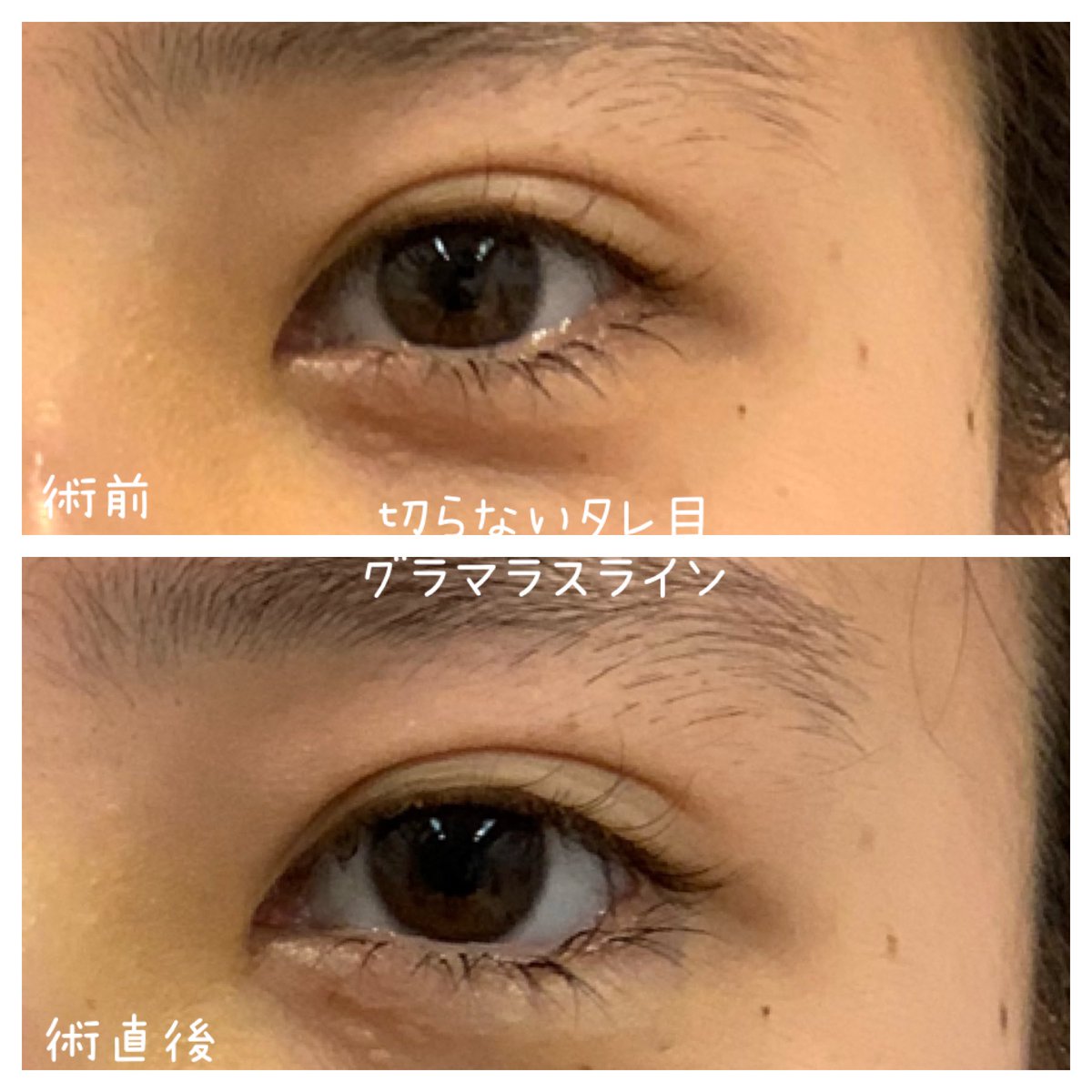 湘南美容クリニック 高松院院長 多田彩子 در توییتر グラマラスライン タレ目 人数限定モニター 円 週末二重術 2点モニター円 切らない眼瞼下垂 人数限定モニター 円 特別モニター 230円 新宿 辻堂院 札幌院 予約 湘南美容クリニック 高松院院長 多田彩子 در توییتر グラマラスライン タレ目 人数限定モニター 円 週末二重術 2点モニター円 切らない眼瞼下垂 人数限定モニター 円 特別モニター 230円 新宿 辻堂院 札幌院 予約