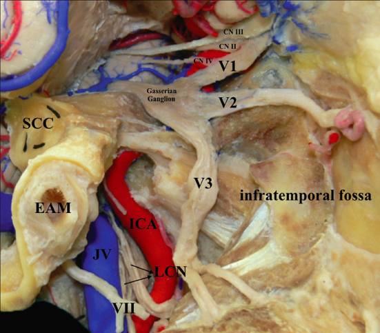 DrBaskaya's tweet image. #Cadaveric image of the #trigeminal nerve branches arising from the trigeminal (#Gasserian) ganglion, extending into the orbit, the pterygopalatine &amp;amp; infratemporal fossae.
journals.lww.com/contempneurosu…
#nsgy #education #skullbase #neurosurgery #neuroanatomy #microsurgery #neurosurgeon