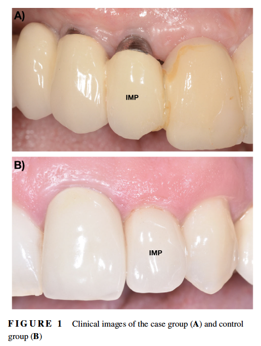 drsanzmartin's tweet photo. Happy to share our latest work where we studied implant soft tissue dehiscences. Implant position was the single most important factor, far more important that the presence of buccal bone @Albertoovc  #perio #implants #dental #dentistry #implantology https://t.co/mAnrOatdwl https://t.co/NpODfnDFzQ