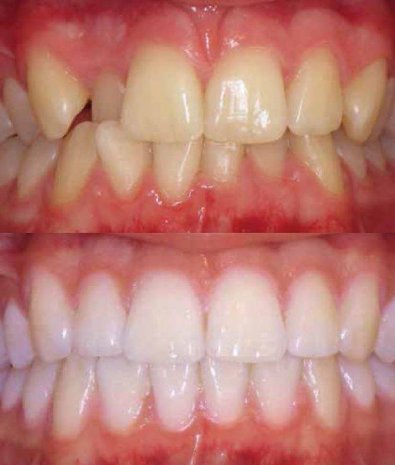 dentalXcell's tweet photo. Boutique Whitening have donated 20 tooth whitening sessions to us. All the money will go to MIND.  They include a free check up and impressions taken for tooth whitening trays aswell a home whitening kit. These normally cost £295 but we are asking for £150 for each kit. https://t.co/zxyIqQNl7F