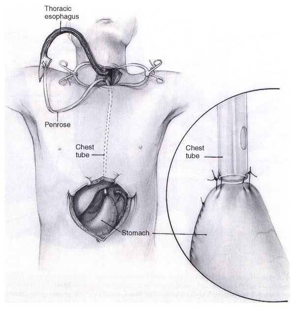 Cirbosque Some4surgery Excellent Dr This A Transhiatal Esophagectomy Plus Gastric Tube Orringer Surgery Thanks A Lot For Your Participation Some4surgery Some4iqlatam T Co Ikeqrgrcau