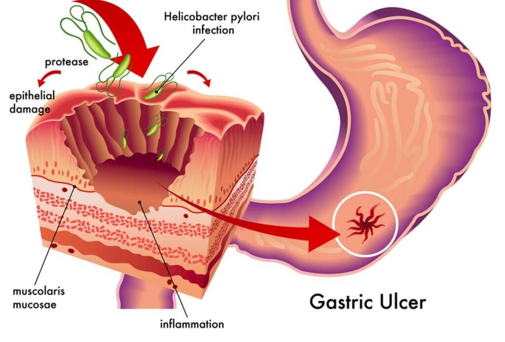 H pylori tratamiento antibiótico