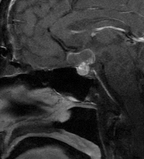 CNS_Update's tweet photo. Review Endoscopic Endonasal Transsphenoidal Resection of a Craniopharyngioma, by Sheri K. Palejwala, Richard Ballena, Alex Corlin, @GarniBDarian, Chester F. Griffiths, and Daniel F. Kelly in Nexus now!
https://t.co/18xB4XGtSw https://t.co/7OZdwLMW4p