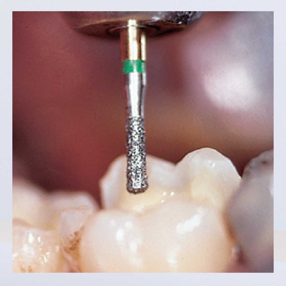 La série "Diamants S" offre réduction de substance plus efficace et rapide lors de vos préparations périphériques ou cavitaires : un gain de temps à la fois bénéfique pour vous-même et votre patient. Plus d'infos sur : komet.fr #Komet