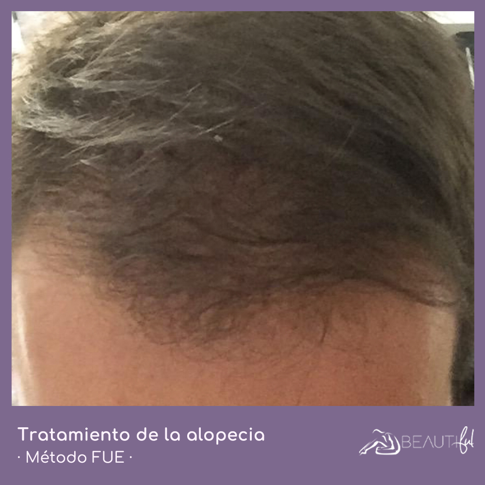 👀Este es el resultado de un caso de alopecia tratado con el método FUE por la Dra. Andrea Romano
✔️Un procedimiento rápido y seguro, poco invasivo y con unos resultados muy naturales👌

📞 977 24 99 06⁣ / 601 98 73 47

#ClinicaBeautifulTarragona  #alopeciatarragona #tarragona