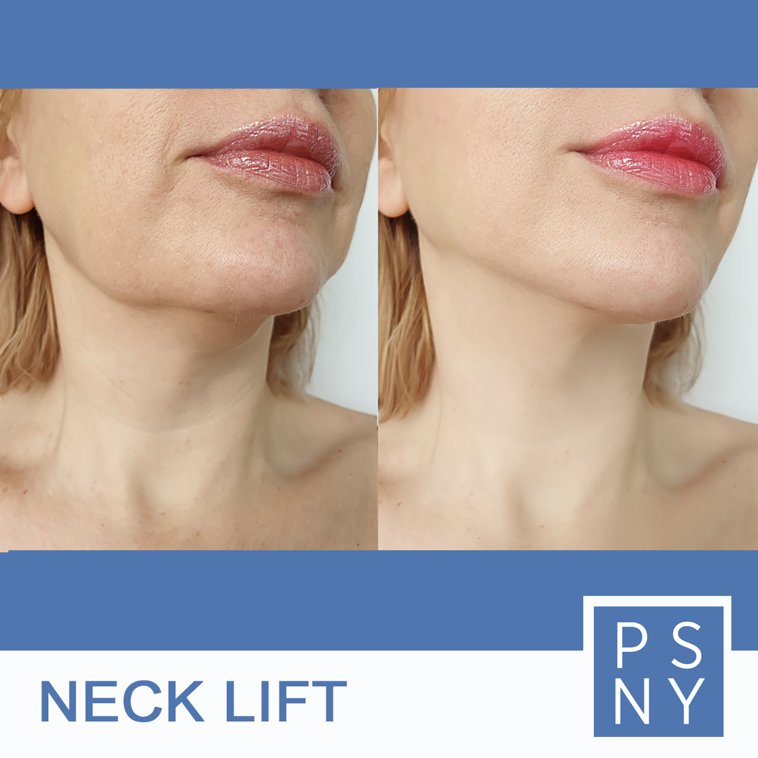 psofny's tweet image. Neck Lift surgery can treat: Excess fat and skin relaxation in the lower face that creates jowls; excess fatty deposits under the chin; loose neck skin; muscle banding in the neck, which created abnormal contours