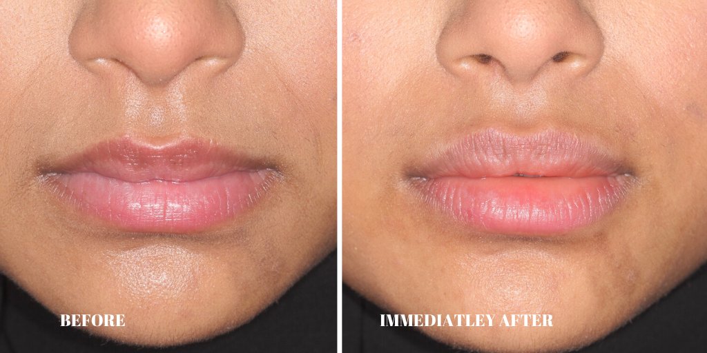 Today's #LipAugmentation case. If you are looking for plumper lips with that bit of extra volume and symmetry, book your consultation today.
drgodarzi.co.uk/treatment/faci… #facialaesthetic #lipfillers #fillers #harleystreet