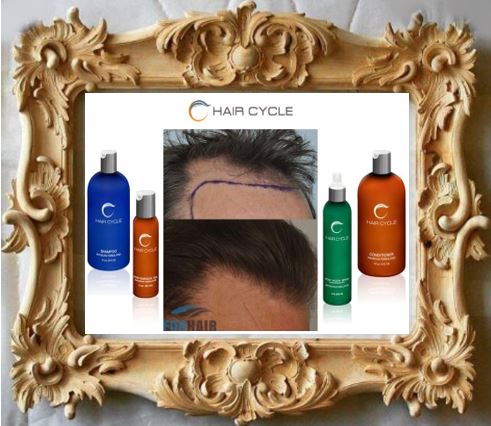 After transplant, HairCycle POST BIOTIN SPRAY helps scalps heal faster and POST SURGICAL GEL is ideal for the recovery. Both with 100% safe ingredients. Find them in THE TRANSPLANT KIT, together with HairCycle Shampoo and Conditioner. See: haircycle.com 
#FUE #forhair