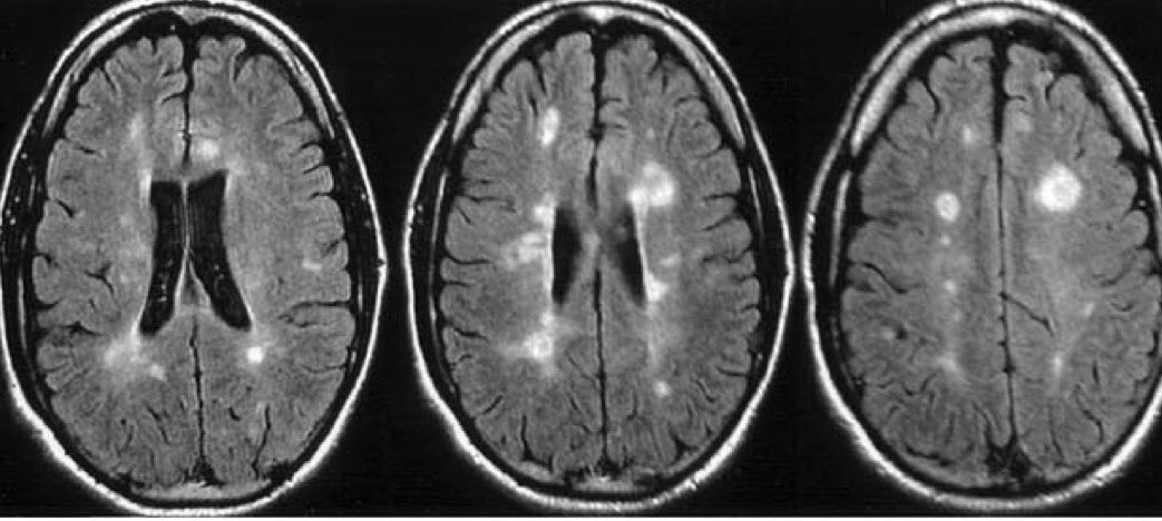 KaylaJacobus's tweet photo. Imaging is a great diagnostic tool! Do you see these bright white spots on this MRI? These lesions are called Dawson’s fingers and are a consistent finding for a patient with Multiple Sclerosis. #neuropathwk6 @juliehershberg https://t.co/vvMuIua5ck