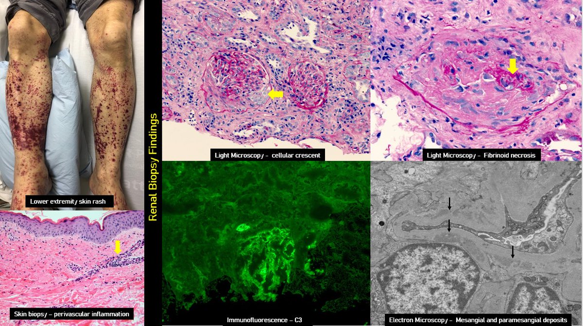 KoraAbhi's tweet photo. Nice case illustrating the commonly encountered #nephrology diagnostic dilemma. Great job @GajapathirajuC @harinipal Thanks for involving me.
#nephpearls #MedEd @UFNephrology @MCW_Nephrology https://t.co/GzT1AAqCir