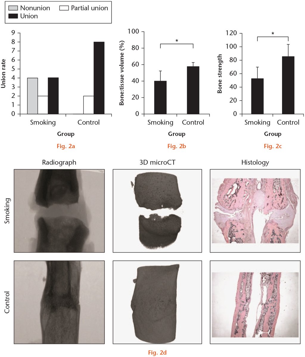 BoneJointRes's tweet photo. JUST PUBLISHED!: Cigarette smoke inhalation impairs #angiogenesis in early bone healing processes and delays fracture union https://t.co/HeNKWD8bda #bonehealing #fractureunion #smoking https://t.co/hJIG8sLp6l