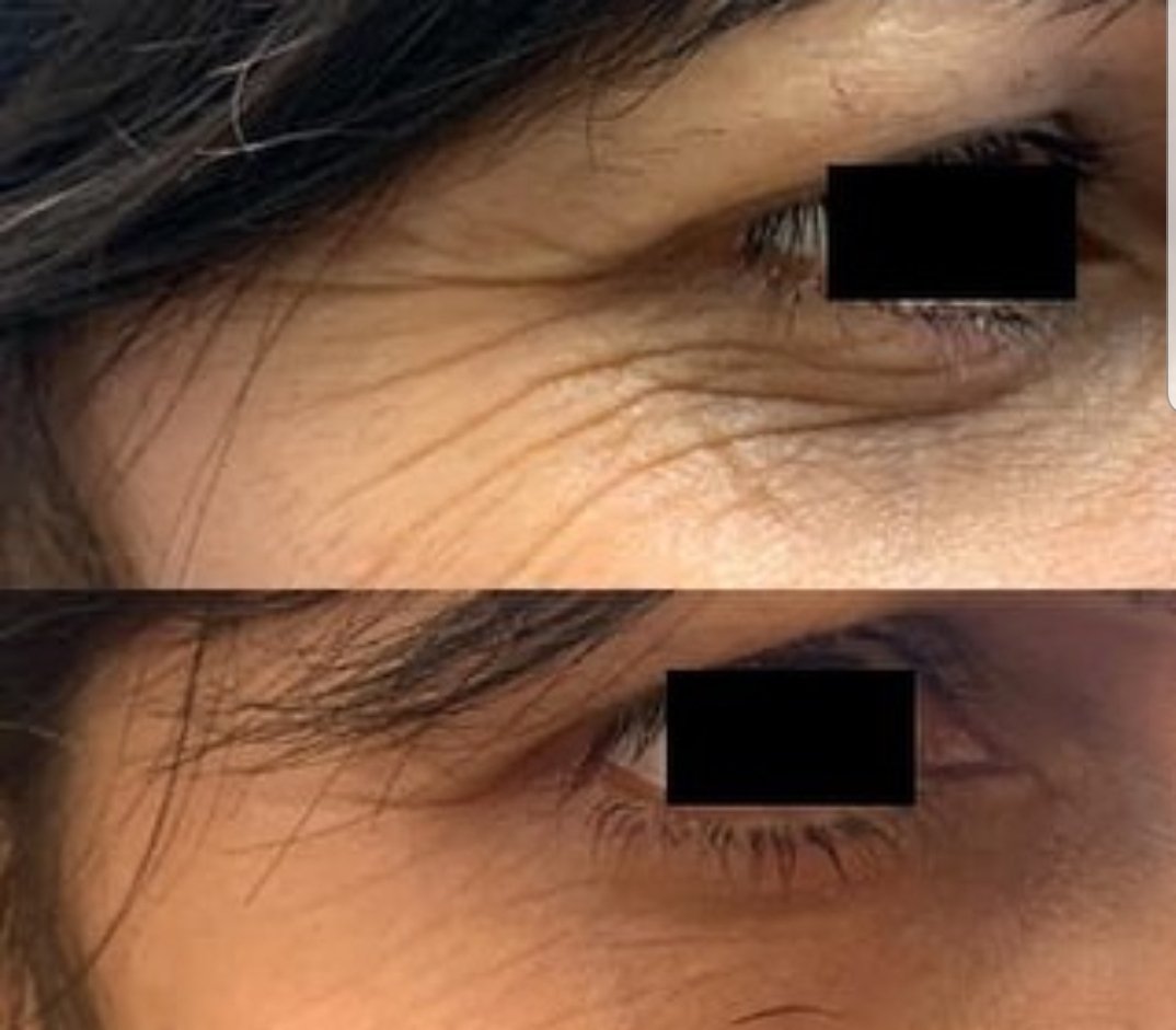 OpAestheticsRT's tweet photo. Amazing Results! 2 weeks of using Radara a patch you simply apply at night, incredible! Creates smoother &amp; youthful skin while reducing wrinkles &amp; lines without the use of needles. Top pic Before. Bottom pic 2 weeks after. To book visit: https://t.co/h2Tq0hm8uD
#youthfulskin https://t.co/zFJkIzkndA