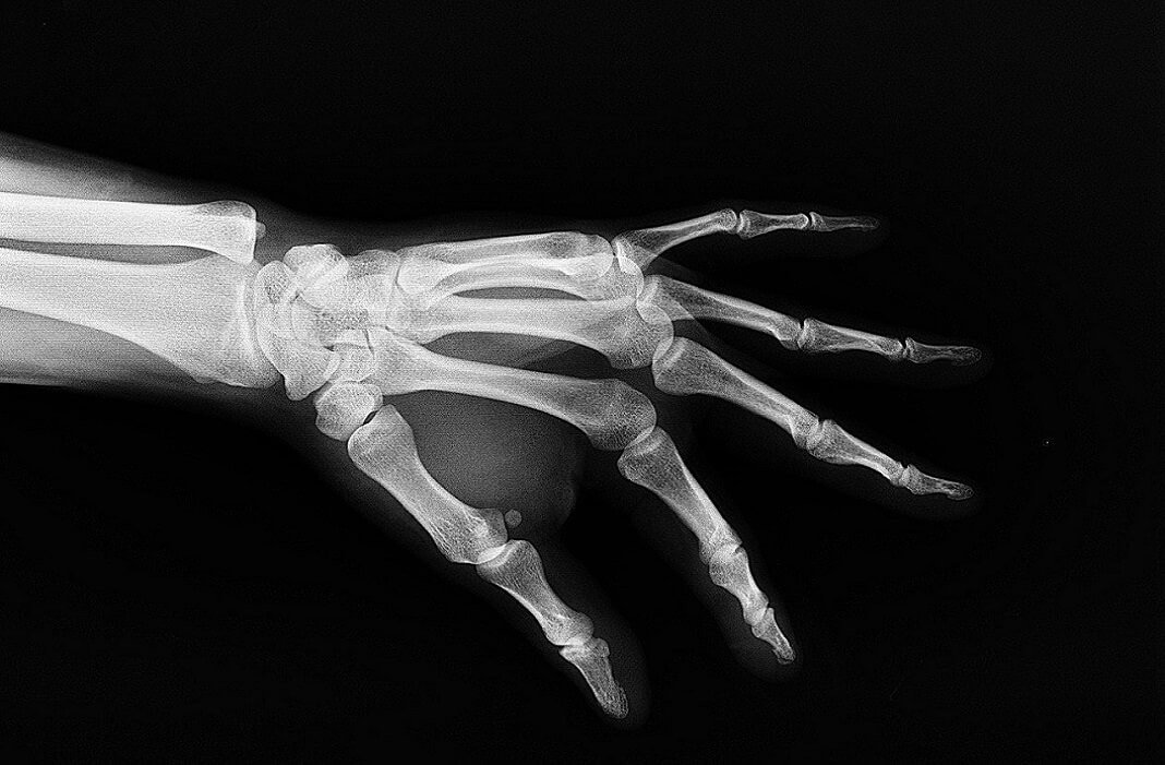 OrthoFeed's tweet photo. Custom-Made Bones Are Being 3D Printed in a Lab Then Implanted in People https://t.co/eb02wGN3nt #3dprinting #bones #CustomImplants #MedTech #MedicalTechnology #orthopedics #orthopaedics #ReconstructiveSurgery https://t.co/ni9m3z3UoF