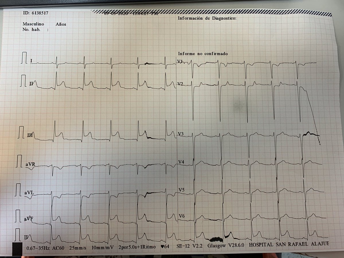 kikkiv's tweet image. Masculino 34 años, conocido hipertenso y diabético el cual no usa tx desde su dx porque “se siente bien”, ingresa por Dolor Precordial que irradia a ambos brazos
#CodeStemi