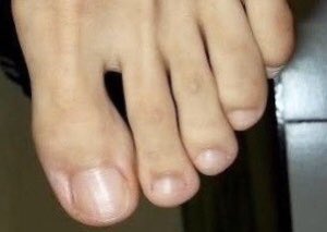 carnirecovering's tweet photo. Carnivores get weak nails &amp; fungal infections due to malnutrition &amp; lack of calcium 
Photo one is my toenails after 7 years as a strict carnivore photo two is my toenails 6 months after stopping eating meat and eating a plant based©️diet 
#Carnivore #Ketogenic #LCHF #meatymarch https://t.co/aER4Xj3m1P